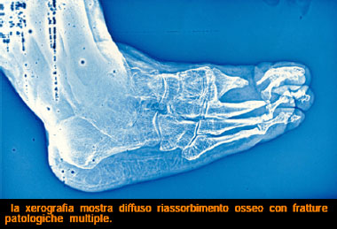 Fratture patologiche da lebbra