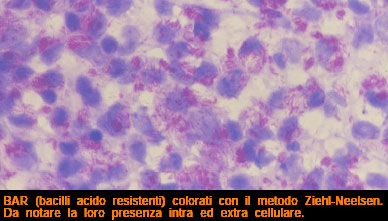 Mycobacterium leprae colorato