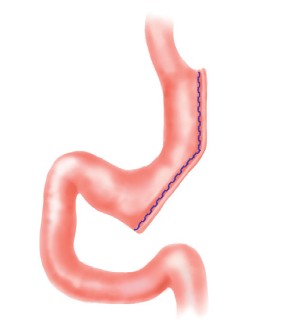 Figura 3. Sleeve Gastrectomy