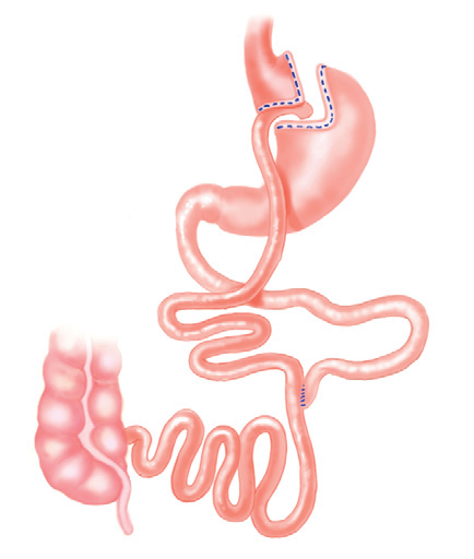 Figura 4. Bypass gastrico