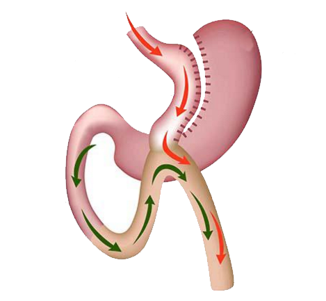 Figura 5. Mini-bypass gastrico