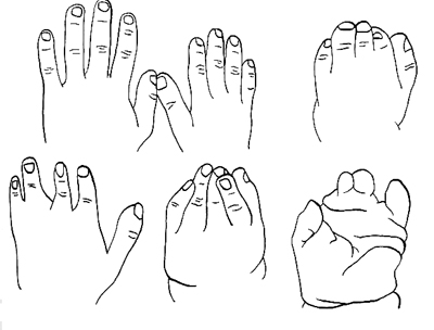 Fig. 2 - Deformazioni arto superiore