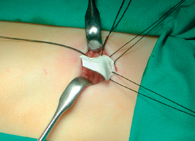 Fig. 4 - Correzione chirurgica con materiale sintetico