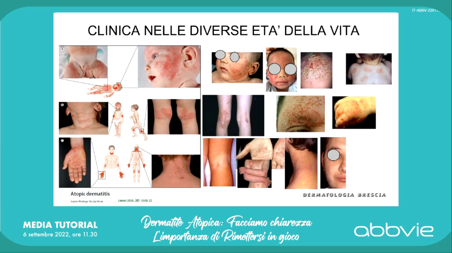 Manifestazioni della dermatite atopica